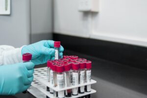 ワキガ手術の剪除法は本当に効果があるの？